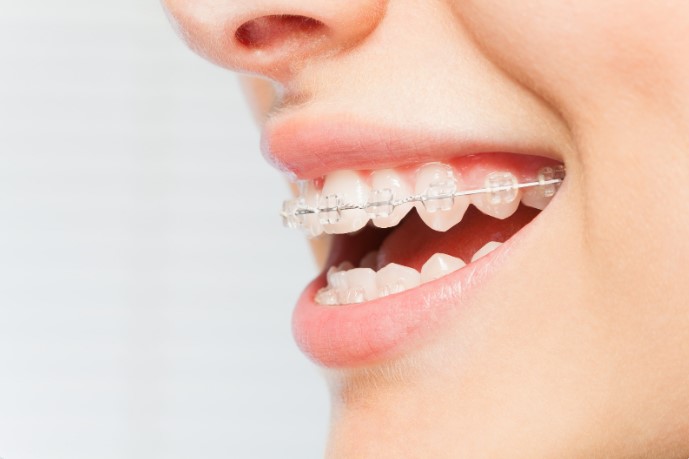 підготовка до брекетів